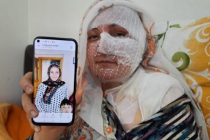 Eşinin kızgın yağ ile yaktığı kadın: Ölmek istemiyorum