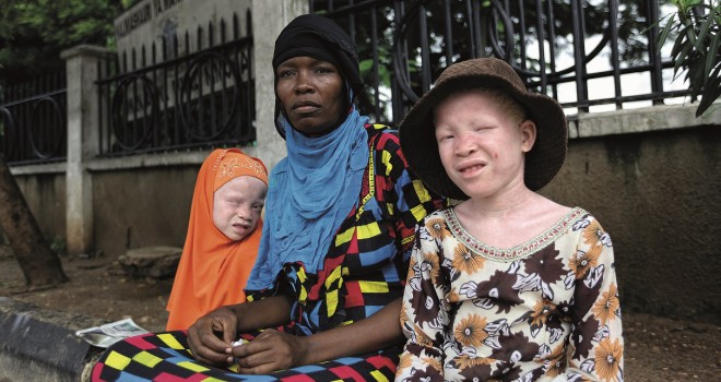 Afrikalı Albinoların Yaşamı İküsag’da